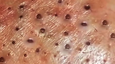 Big Deep Blackheads And Huge Cyst Pops .